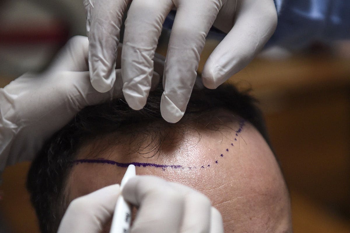 hair-transplant-cost-surgery-01